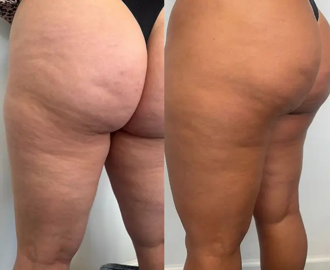 Tratamiento de Celulitis - Bioestimulación